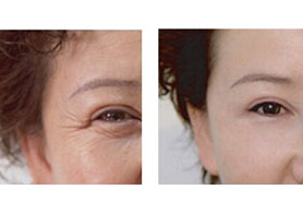 德宏眼部除皺價格