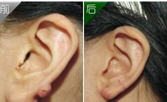 棗莊耳垂畸形修復價格