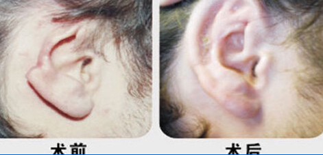 棗莊耳輪缺失修復價格