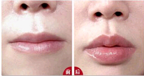 汕頭薄唇增厚價格
