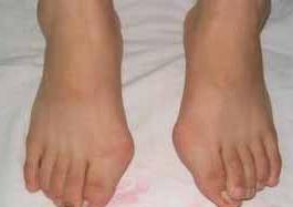 德宏拇外翻(大腳骨)矯正價(jià)格