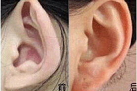 汕頭招風(fēng)耳整形價(jià)格