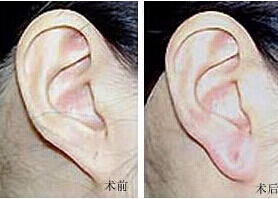 汕頭豐耳垂價格