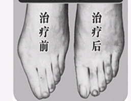汕頭寬腳變窄價格