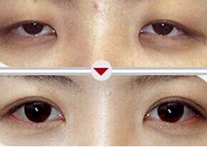 惠州上瞼松弛矯正價格