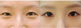 惠州眼瞼下垂矯正價格