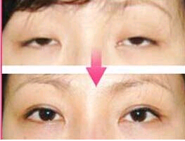 惠州下瞼外翻矯正價格