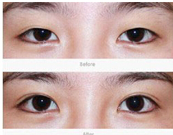 嘉興水泡眼矯正價(jià)格
