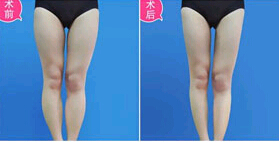 惠州360度環(huán)形吸脂價格