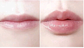 惠州唇珠成形價格