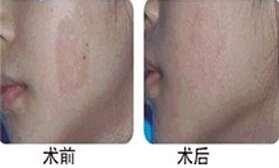 惠州咖啡斑價格