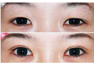 青島雙眼皮失敗修復(fù)價(jià)格