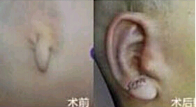 惠州耳部再造價格