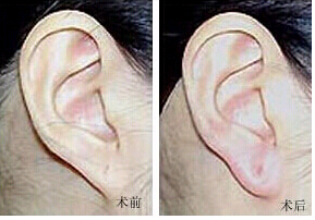 惠州耳垂加大價格