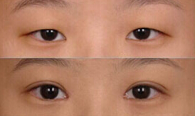 青島眼瞼下垂矯正價格