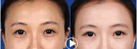 惠州眼部除皺價格