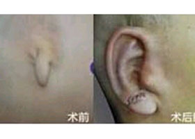 嘉興耳部再造價格