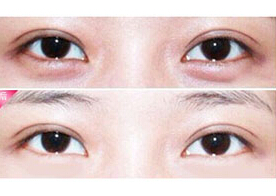 青島瞼眶溝填充價(jià)格