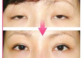 青島下瞼外翻矯正價格