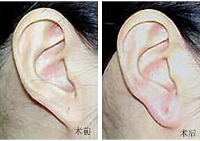 嘉興耳垂加大價格