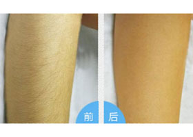 湖州前臂脫毛價格
