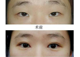 青島眼瞼缺損局部植皮修復(fù)價格
