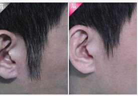 肇慶發(fā)際線脫毛價格