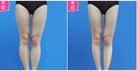 肇慶小腿吸脂價(jià)格
