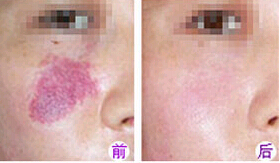 肇慶鮮紅斑痣價(jià)格