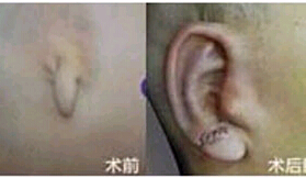 肇慶耳部再造價(jià)格