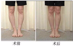 肇慶O型腿矯正價格