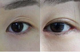 云浮雙眼皮失敗修復價格