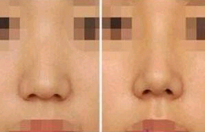云浮人中加深價格