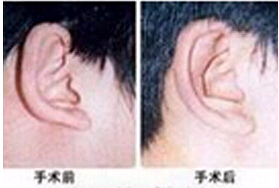 云浮招風耳整形價格