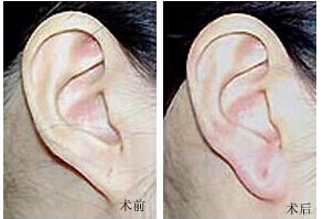 云浮耳垂加大價格