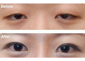 梅州眼瞼下垂矯正價格