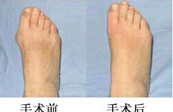 云浮拇外翻（大腳骨）矯正價格