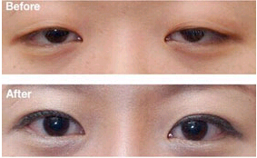 揭陽眼瞼下垂矯正價格
