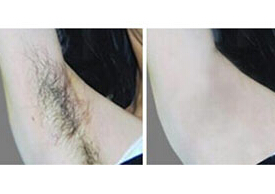 梅州脫腋毛價格
