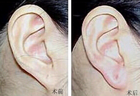 揭陽(yáng)耳垂加大價(jià)格