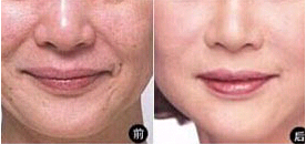 揭陽熱瑪吉除皺價(jià)格