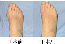 揭陽拇外翻（大腳骨）矯正價格