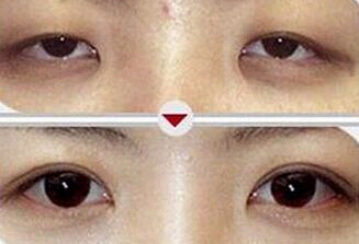 紹興上瞼松弛矯正價(jià)格