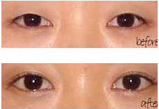 紹興眼瞼缺損整復術價格