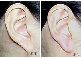 梅州耳垂加大價(jià)格