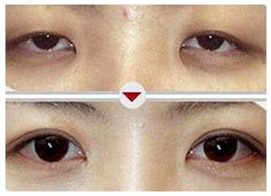 麗水瞼眶溝填充價格