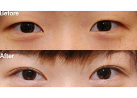舟山眼瞼下垂矯正價(jià)格