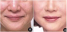 紹興熱瑪吉除皺價格
