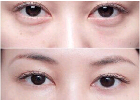 臺州祛眼袋價格