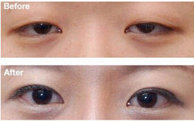 臺州眼瞼下垂矯正價格